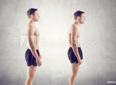 Fototapeta100 x 73  Man with impaired posture position defect scoliosis and ideal, 100 x 73 cm