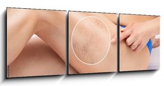 Obraz 3D třídílný - 150 x 50 cm F_BM524125512 - Beautiful slender woman sits on a couch in a spa salon. She shows varicose veins in the lower legs.Treatment of varicose veins and capillaries.