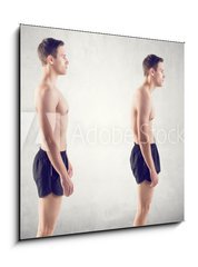 Obraz 1D - 50 x 50 cm F_F66813369 - Man with impaired posture position defect scoliosis and ideal